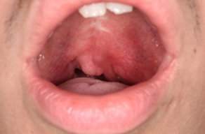 sign of abscess in the throat
