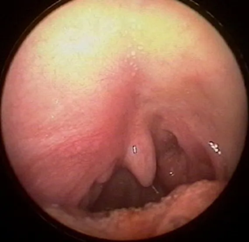 sign of abscess in the throat