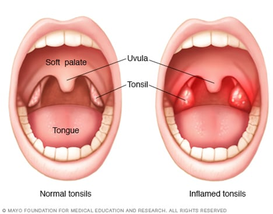 Normal tonsils and tonsillitis diagram