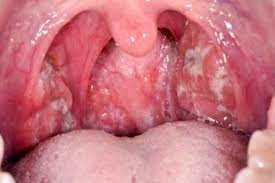 Infected tonsils