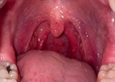 Normal tonsils